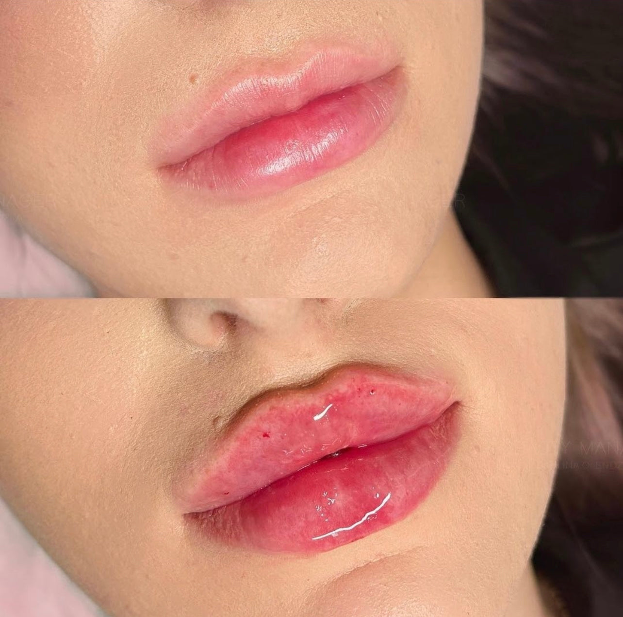 Rejuvenecimiento facial/Face Rejuvenation (BOTOX)