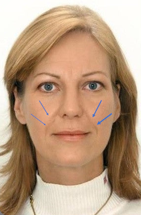 Corrección del surco nasolabial con relleno