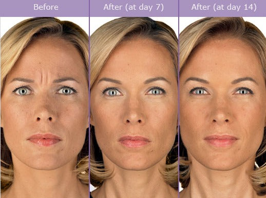 Rejuvenecimiento facial/Face Rejuvenation (BOTOX)