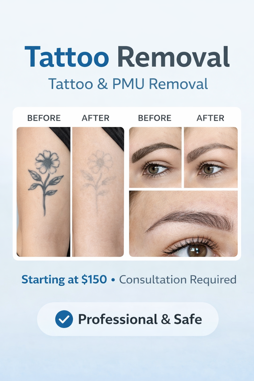 Tattoo Remover – Remoción de Tatuajes y Micropigmentación